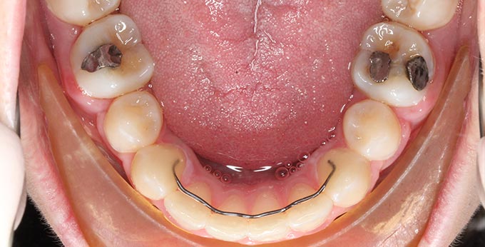 Adult lower teeth after Orthodontic treatment for severe dental crowding and misalignment